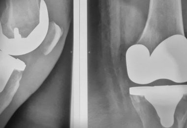 Artrosis, prótesis y recuperación de rodilla